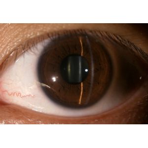 3.5" Ophthalmology Diagnostic Equipment For Glaucoma Diabetes