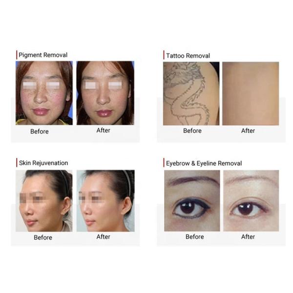 2 In 1 Pico Laser Diode Hair Removal And Picosecond Laser Tattoo Removal Machine