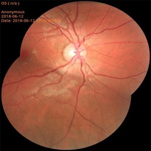Mini Fundus Photography Equipment Near Infrared Light Imaging Technology