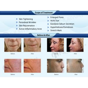 CE /FDA approved technology nubway newest fractional rf microneedle/microneedlin