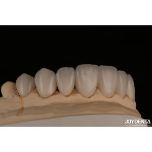 Feldspathic Natural Looking Cosmetic Veneers Precise Fit Highly Translucent