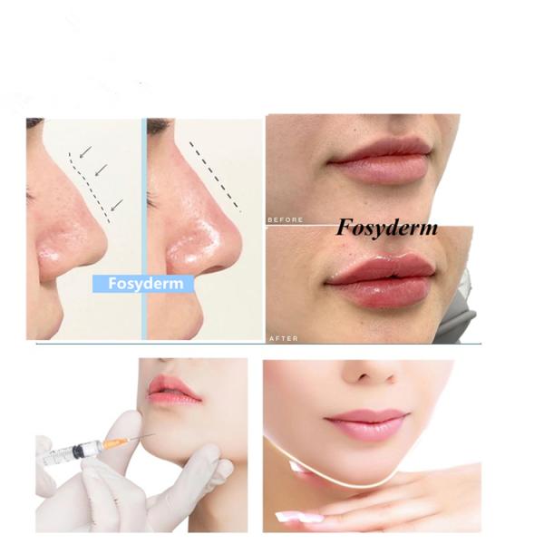 Medical 2ml Hyaluronic Acid Dermal Filler For Lips Chin Nose Lidocaine