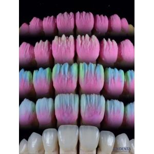 The Joydenta Ceramic Veneer Process