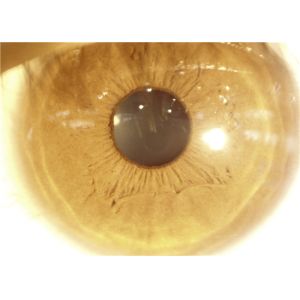 Handheld Slit Lamp Portable Ophthalmoscope Camera