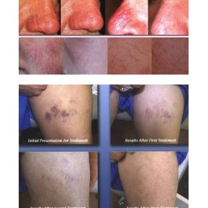 flat warts removal with good immediate results