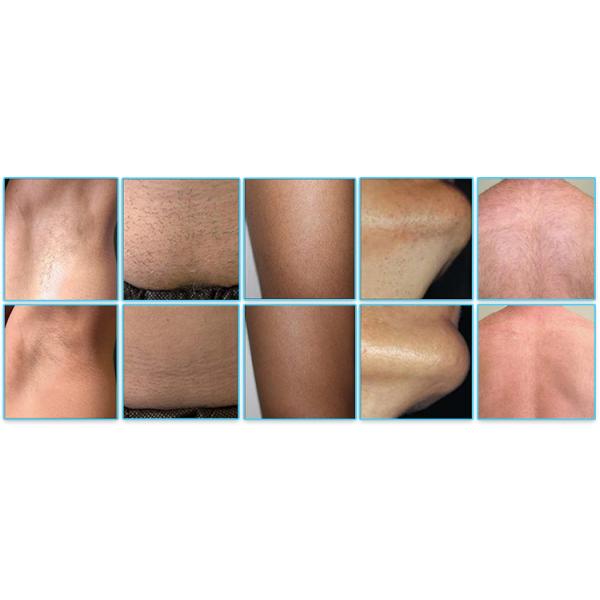 Portatil Long Pulse Laser Hair Removal Equipment Direct Coupling