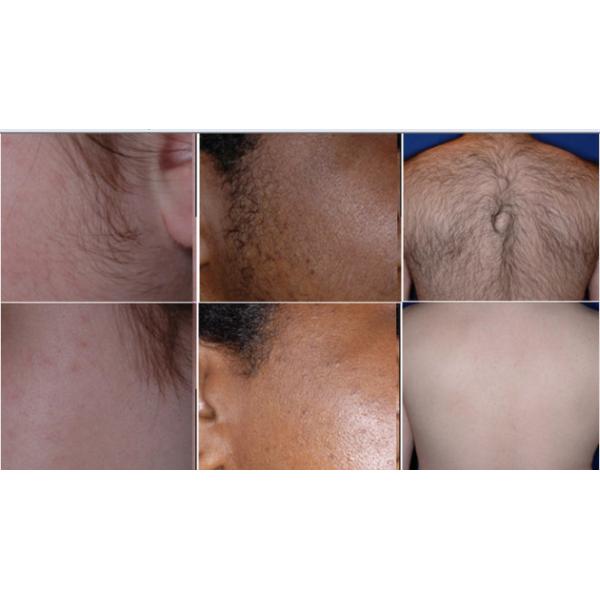 best professional ipl machine for hair removal fda approved ipl laser machine