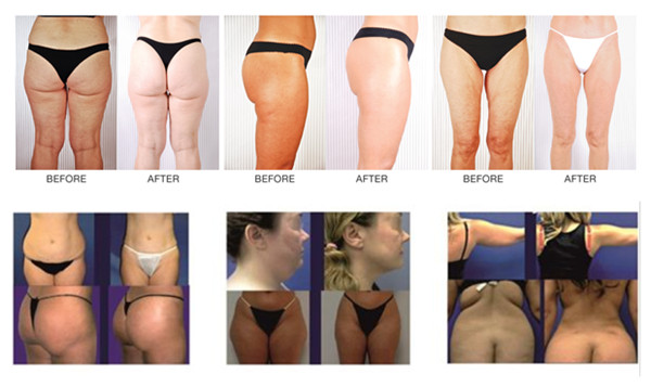 Vacuum Sliming Machine For Body Contouring , Cellulite Removal , Skin Lfiting