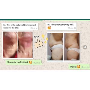 cryo360 cryolipolysis machine price/fat removal machine cryolipolysis slimming