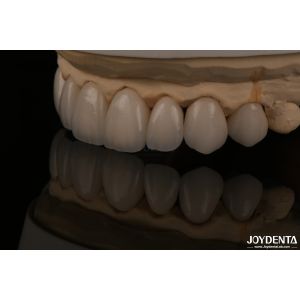 Feldspathic Natural Looking Cosmetic Veneers Precise Fit Highly Translucent