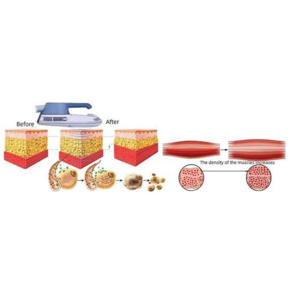 Air Cooling Body Sculpting Machine Hiemt Beautiful Muscle Machine