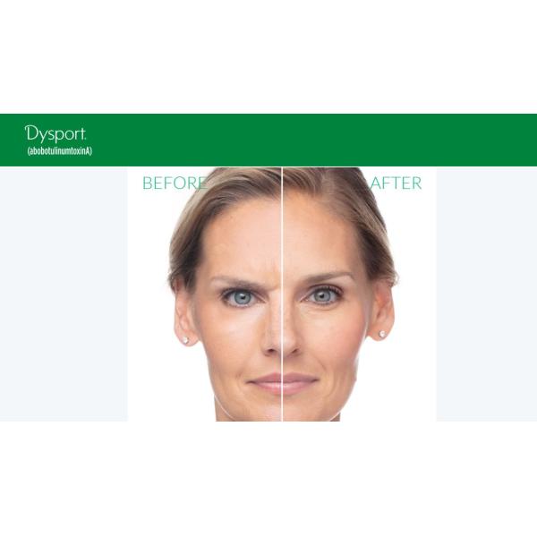 Botulinum Toxin Dysport CE Anti Aging For Anti Wrinkle Botulinum Injection
