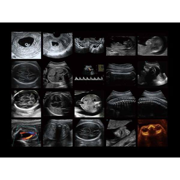 500GB SonoScape Ultrasound Machine P50 With Five Sockets