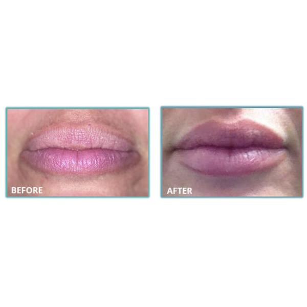 Juvederm Voluma Injectable Dermal Filler 2*1ml 24mg HA Dermal filler