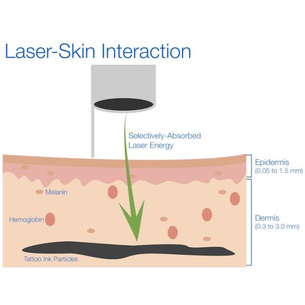 Laser-Skin-Interaction1.jpg