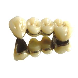 Quality Teeth Color Cobalt Chromium Crown PFM High Noble Dental PFM for sale
