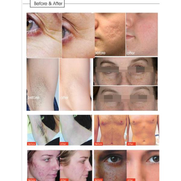 Wrinkle Therapy Shr Ipl OPT Hair Removal Machine For Beauty Spa