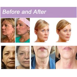 Anti Aging PDO Collagen Threads Polidioxanona Sutura Face Lifting