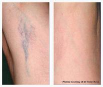 2 In 1 Multifunctional DPL Hair Removal ND YAG Laser Tattoo Removal