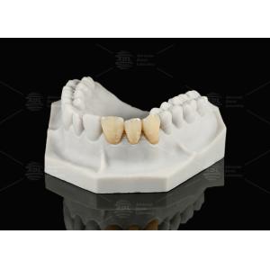 Durable Hypoallergenic EMAX Bridge Extreme Esthetics Emax Dental Bridge