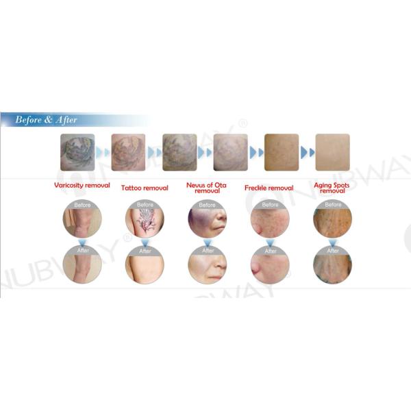 q-switch laser high energy 1500mj short pulse 8ns best laser tattoo removal machine