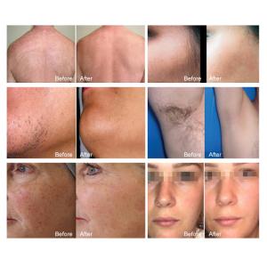 Professional Soprano Titanium 808nm Diode Laser Beauty Machine