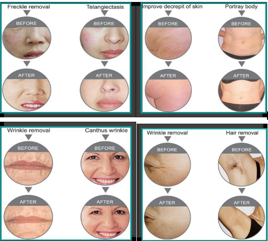 Portable Beauty Salon Use E - Light IPL RF Machine Pressional Hair Removal