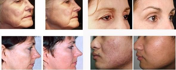 Perfect Beauty Salon Use Latest Fractional RF Micro Needle Thermal System