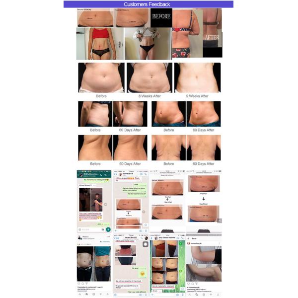 Kes 4 handles cool cryotherapy Cellulite Reduction Body Tightening Machine