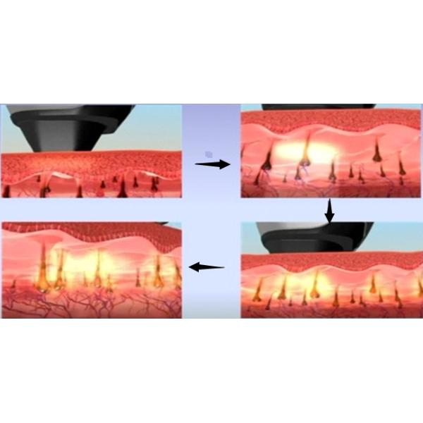 Women Multifunction 5 in 1 galvanic facial machine 1064 Nm Nd Yag Laser , Tattoo Laser Removal Equipments