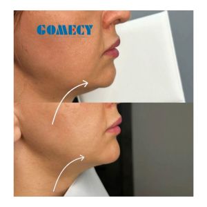 Facial Rejuvenation Skin Lifting T-Shock Treatment Therapy Cool Sculpting