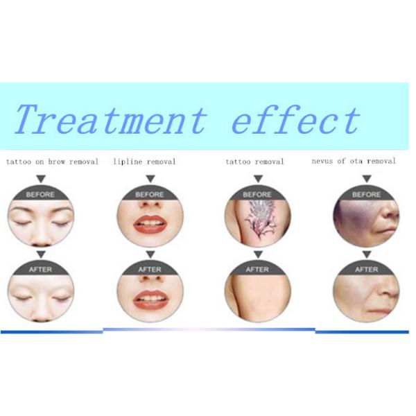 10.4 Inch Touch Screen ND YAG Q - Switched Laser For Tattoo Removal