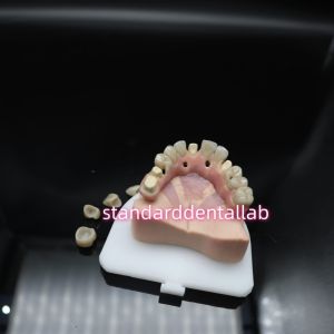 Digital Dental Malo Implant Bridge Titanium Ivoclar Hybrid Zirconia Bridge