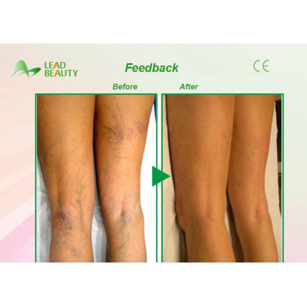 30Mhz spider vein removal machine laser varicose vein removal treatment