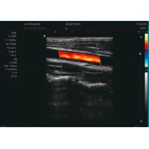 Doppler Ultrasound In Pregnancy Home Doppler Ultrasound Probe Frequency 12MHz