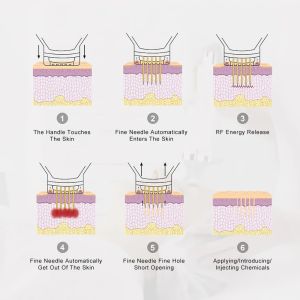 Portable Skin Tightening Radio Frequency RF Microneedling Machine Wrinkle