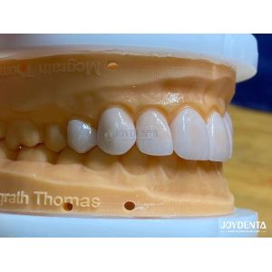 High Permeability Natural Looking Veneers Porcelain Veneers Emax Customized