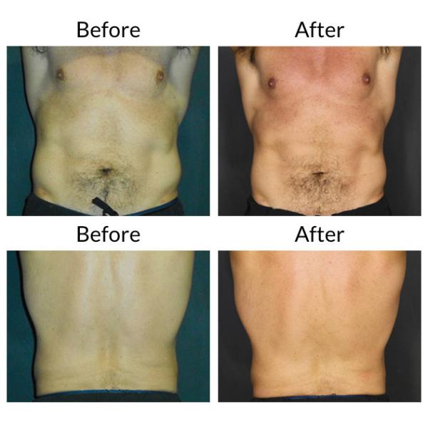 Lcd Cryolipolysis Slimming 650nm Portable Fat Freezing vacuum slimming Machine