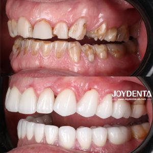 Zirconia dentures that imitate natural teeth