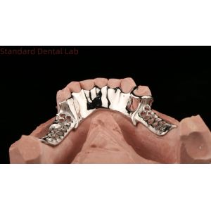 Cobalt Chrome Cast Metal Framework Partial Dentures With Lower Apron Design SDL Dental Lab