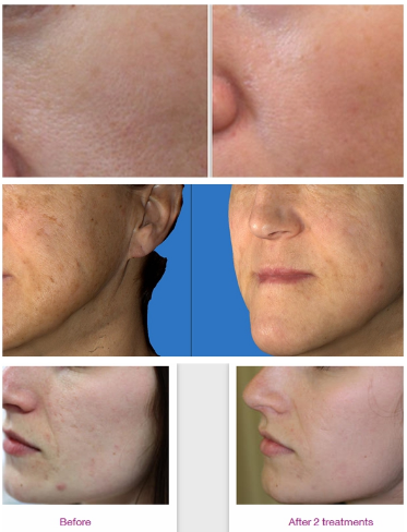 Jet Clear Facial Machine Water Oxygen Jet Peel Machine Skin Rejuvenation Machine