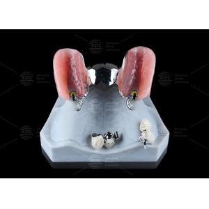 Silver Key And Keyway Attachment Easy Maintenance Precision Attachment Dental