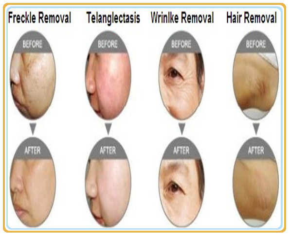 1200W E Light Ipl RF Beauty Machine For Body Hair Removal Pigment Remove