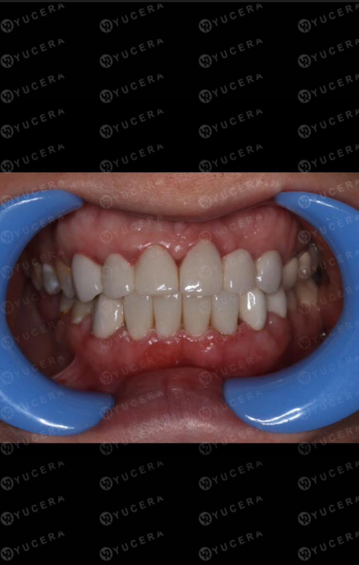 Yucera ST color Dental Zirconia Blocks Your Trusted Choice for Lifelike Dental Restorations