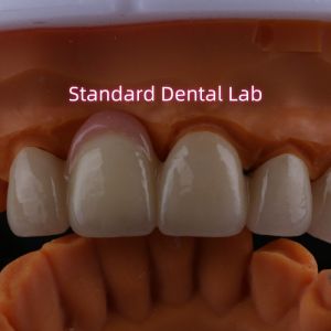 Highly Biocompatible PFZ Porcelain Layered Zirconia With Pink Gum