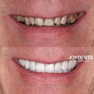 Zirconia dentures that imitate natural teeth