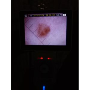 1920x1080 Digital Video Dermatoscope