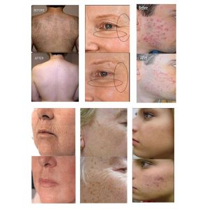 Quality E-light ipl rf system ipl shr hair removal machine male female permanent facial and body for sale