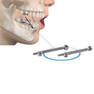 Quality Herbst Appliance Jaw Corrector 18-31mm Stainless Steel Orthodontic for sale
