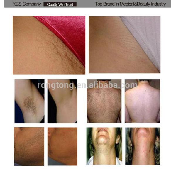 3 Handles E-lite Machine IPL RF Hair Removal/Acne Removal/Vascular Treatment Machine